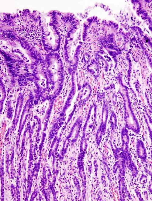 Histologický náraz žaludečního karcinomu s maligními žlázami.