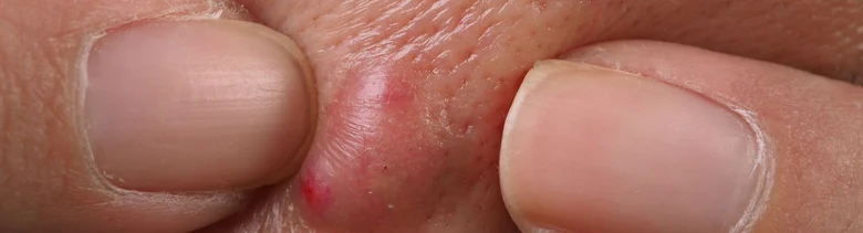 Zvětšený červený hrbol na kůži mezi prsty ukazující absces.
