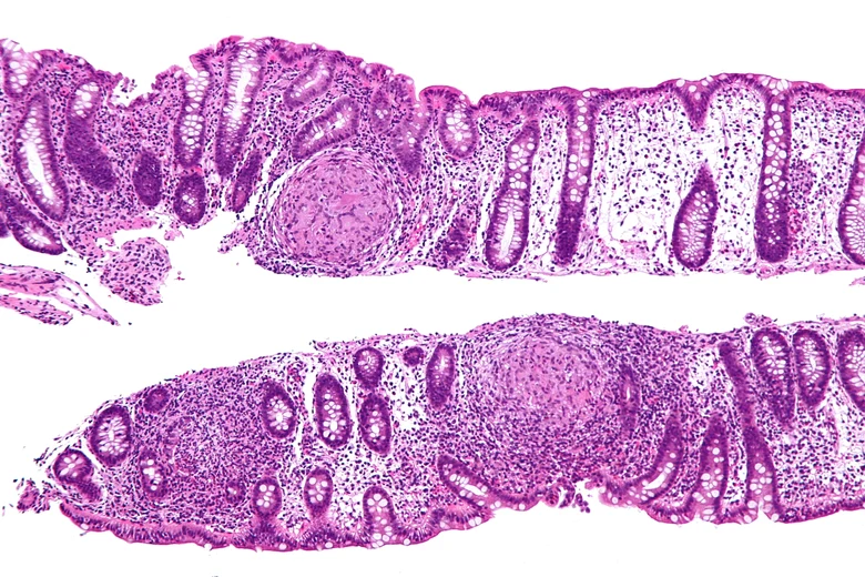 Histologický příznak Crohnovy choroby s granulomem v tlustém střevě.