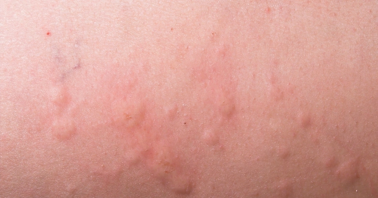 Zvětšený záběr na vyrážku s červenými pupínky a otokem kůže.