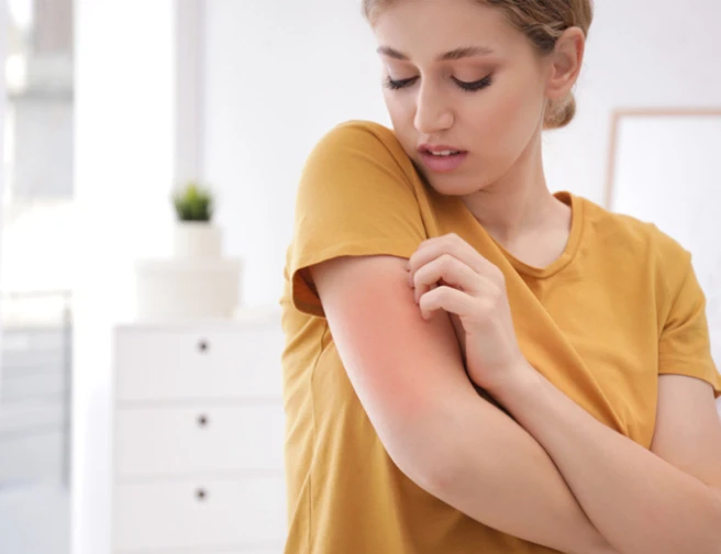 Woman scratching mosquito bite