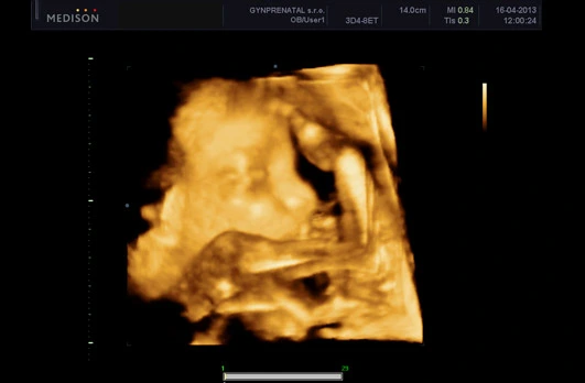 3d ultrasound fetus